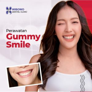 mengatasi gummy smile 