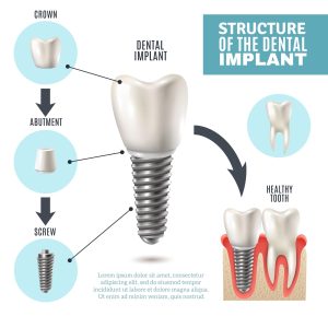 dental implan